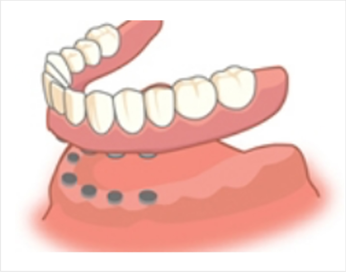 即時(仮)義歯の適任者は誰ですか?