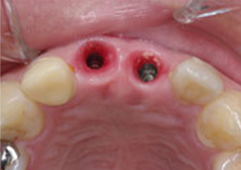 インプラント埋入後の歯茎の写真